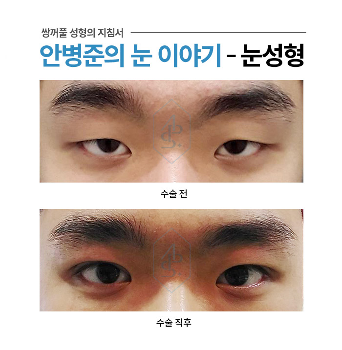 쌍꺼풀 수술에서 부기란? - 수술직후 붓기 사례 모음 관련 이미지 3
