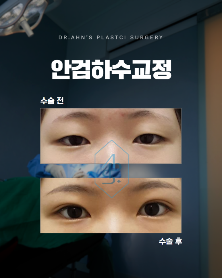 안검하수교정 눈이 항상 무겁고 피곤해 보인다면 관련 이미지 1