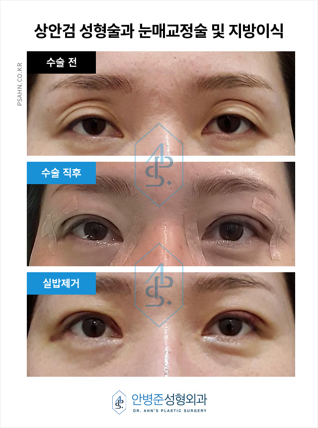 [눈성형]눈꺼풀 피부 처짐과 안와지방 소실 수술 사례 관련 이미지 1