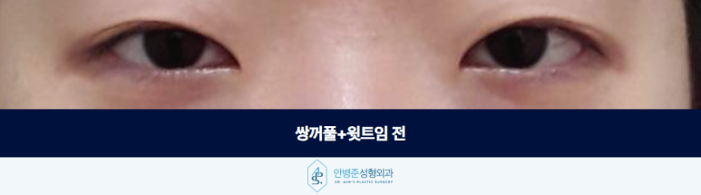 윗트임 가짜안검하수 눈매교정 필요하지 않은 경우 관련 이미지 2