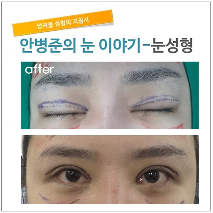 2년전 수술개선(중국환자) 관련 이미지 2