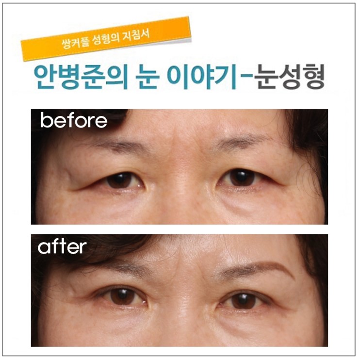 상안검성형술 관련 이미지 1