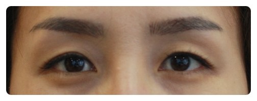 눈성형+눈지방이식 시크릿성형외과_안병준 관련 이미지 3