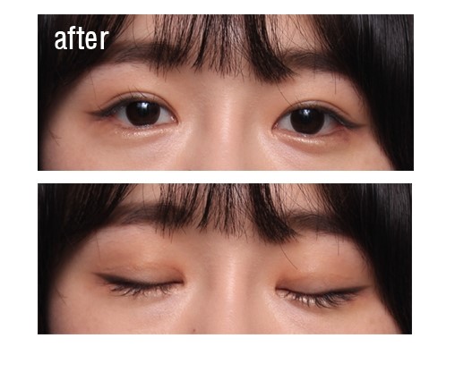 4년전 잘못된 절개법 수술후. 관련 이미지 2