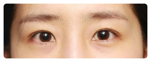 눈성형 4개월후 경과사진 관련 이미지 4