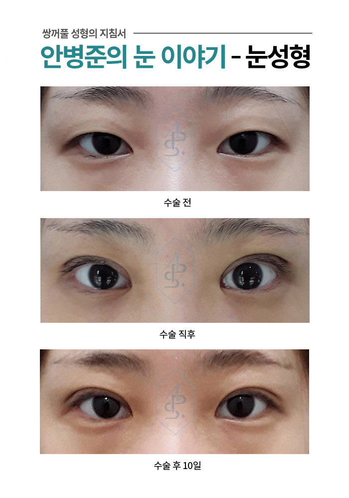 [쌍꺼풀수술] 짝눈 두눈의 크기를 맞춘 눈매교정술 관련 이미지 1
