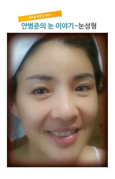 자연스런 쌍꺼풀2_시크릿 성형외과 안병준의 쌍꺼풀 지침서 관련 이미지 3