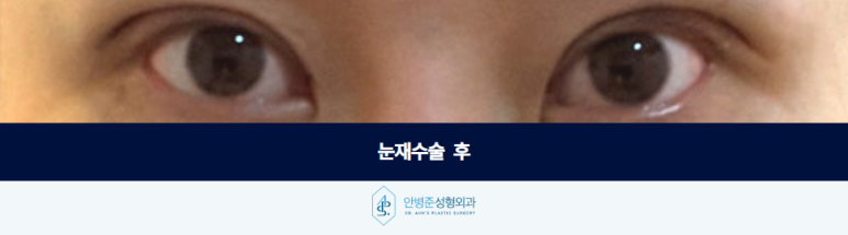 눈재수술 이전 수술의 흔적을 자연스럽게 디자인하는 과정 관련 이미지 3