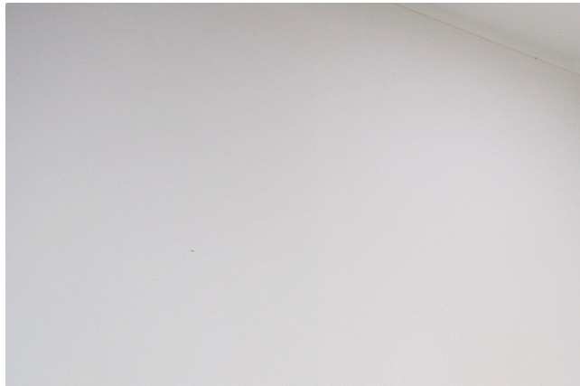 꺼진눈지방이식 볼륨을 채우기 전에 먼저 고려해야 할 점은 관련 이미지 9