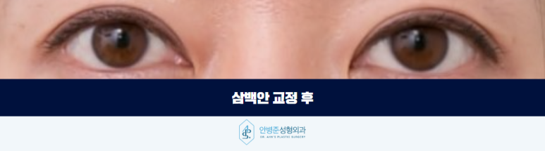 삼백안 교정 원인을 먼저 세심하게 봐야 합니다 관련 이미지 3