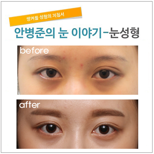 짝짝이 눈과 삼백안 고치기(삼백안,재수술) 관련 이미지 1