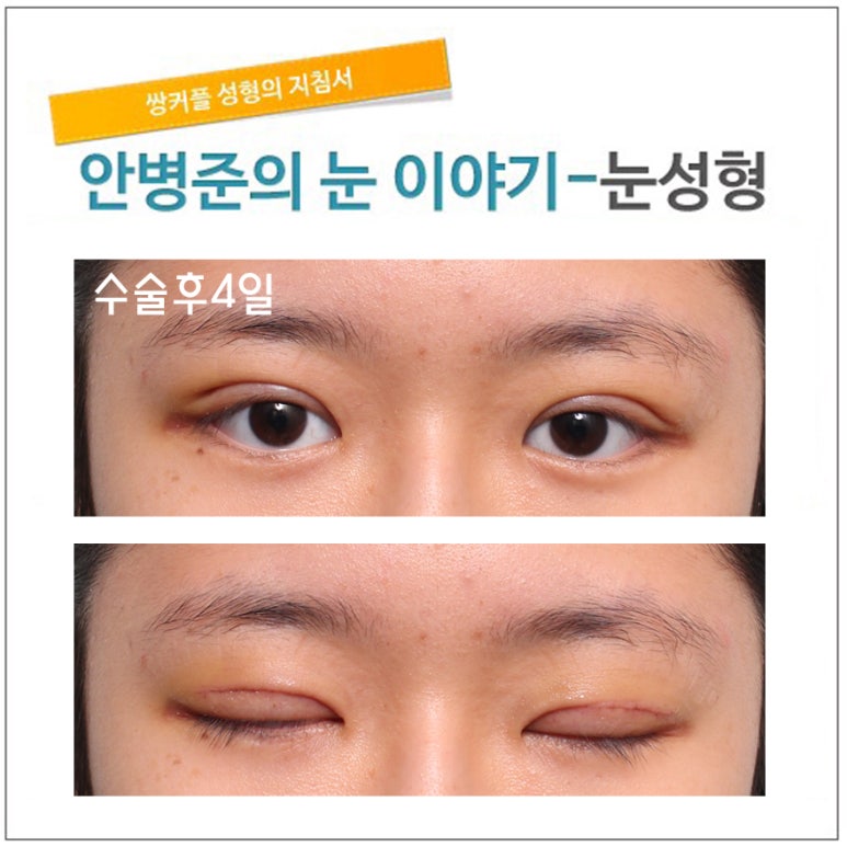 동양인 눈(자연 쌍꺼풀,자연스러운쌍꺼풀수술) 관련 이미지 2