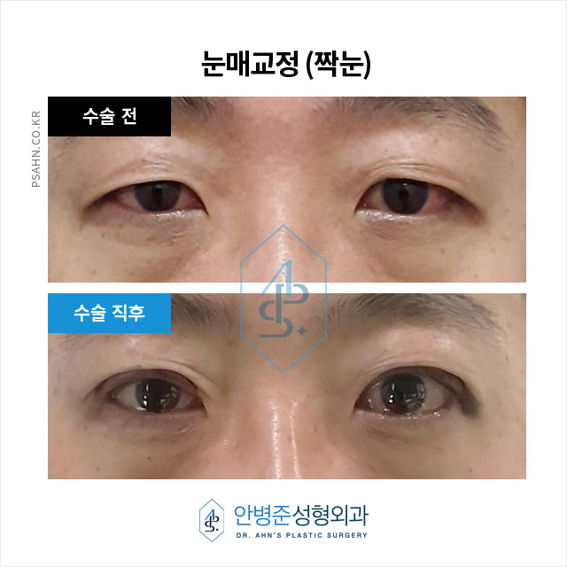 [짝눈성형]남자 짝눈 교정, 단순 쌍수로는 부족한 이유 관련 이미지 1