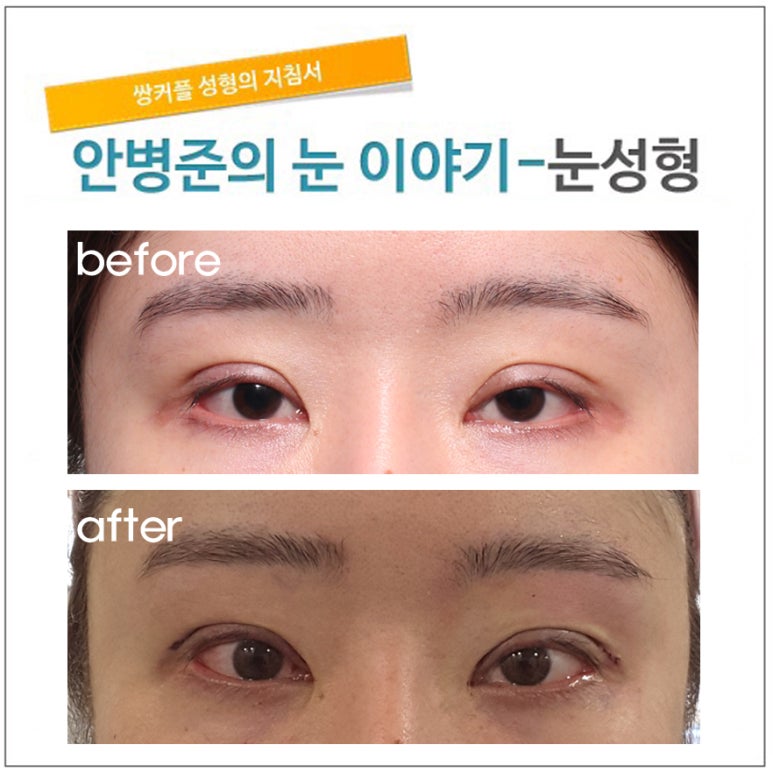 한달 5번의 수술과 교정.(재수술,쌍꺼풀재수술,눈매교정) 관련 이미지 1