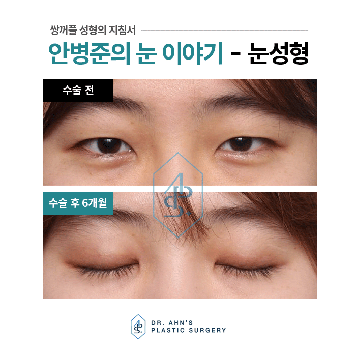 원하는 쌍꺼풀? 수술방법도 선택도 모두 다릅니다. 관련 이미지 3