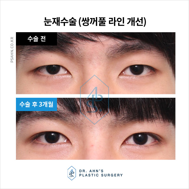 눈성형재수술,왜 필요한 걸까요? 흔한 실패 원인 분석 관련 이미지 3