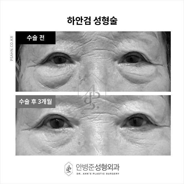 처진눈, 그늘진 눈 밑 노화, 또렷한 눈매와 건강함을 위한 상안검과 하안검 성형술 관련 이미지 3