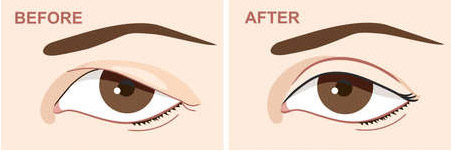[강남역성형외과] 눈썹거상술? 눈썹밑절제술? 눈밑지방재배치? 관련 이미지 4