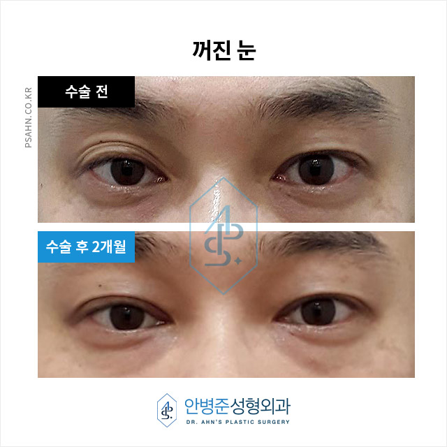 [남자눈성형] 남자 쌍꺼풀, 여자와 다른 자연스러움의 포인트? 관련 이미지 6