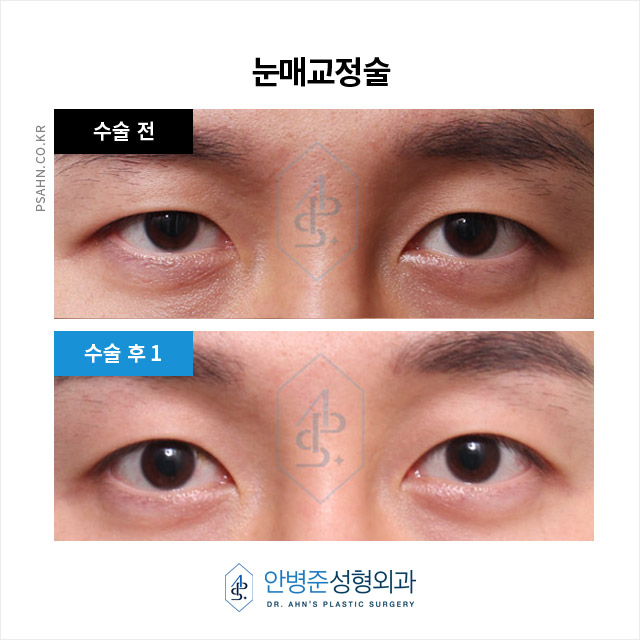 [남자눈성형]주변에서 자꾸 째려만 본다고.. 이유를 알려달라고 ㅠ 관련 이미지 3