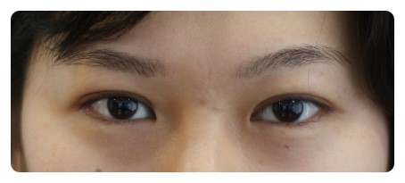 쌍커풀수술 경과_1개월후 관련 이미지 2