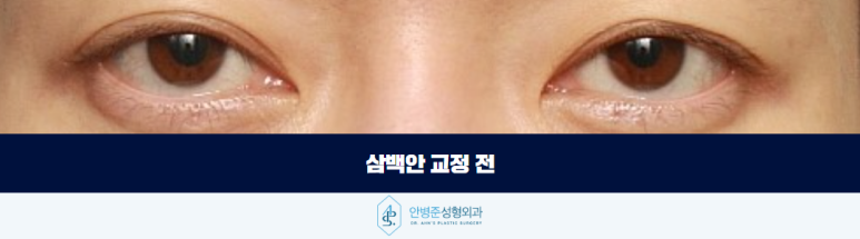 삼백안 교정 원인을 먼저 세심하게 봐야 합니다 관련 이미지 2