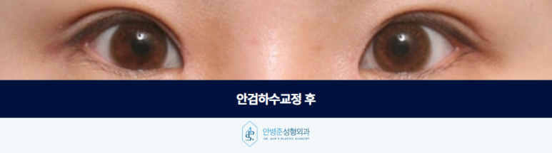 Before Correcting Ptosis, You Must First Determine Whether Skin Sagging Is the Cause image 3
