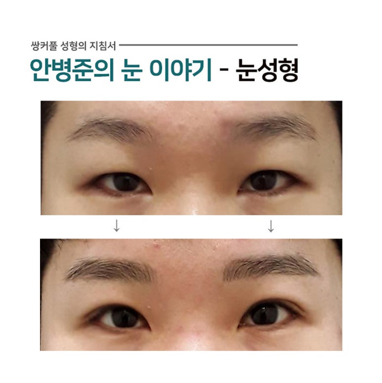 절제법과 눈매교정술(피부절제,눈매교정) 관련 이미지 1