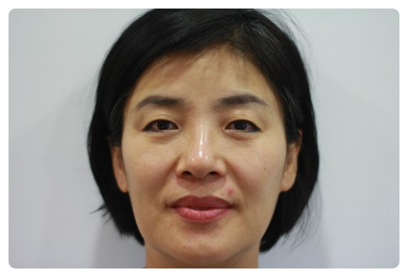 *상안검성형술*                      [안병준의 눈이야기] 관련 이미지 1