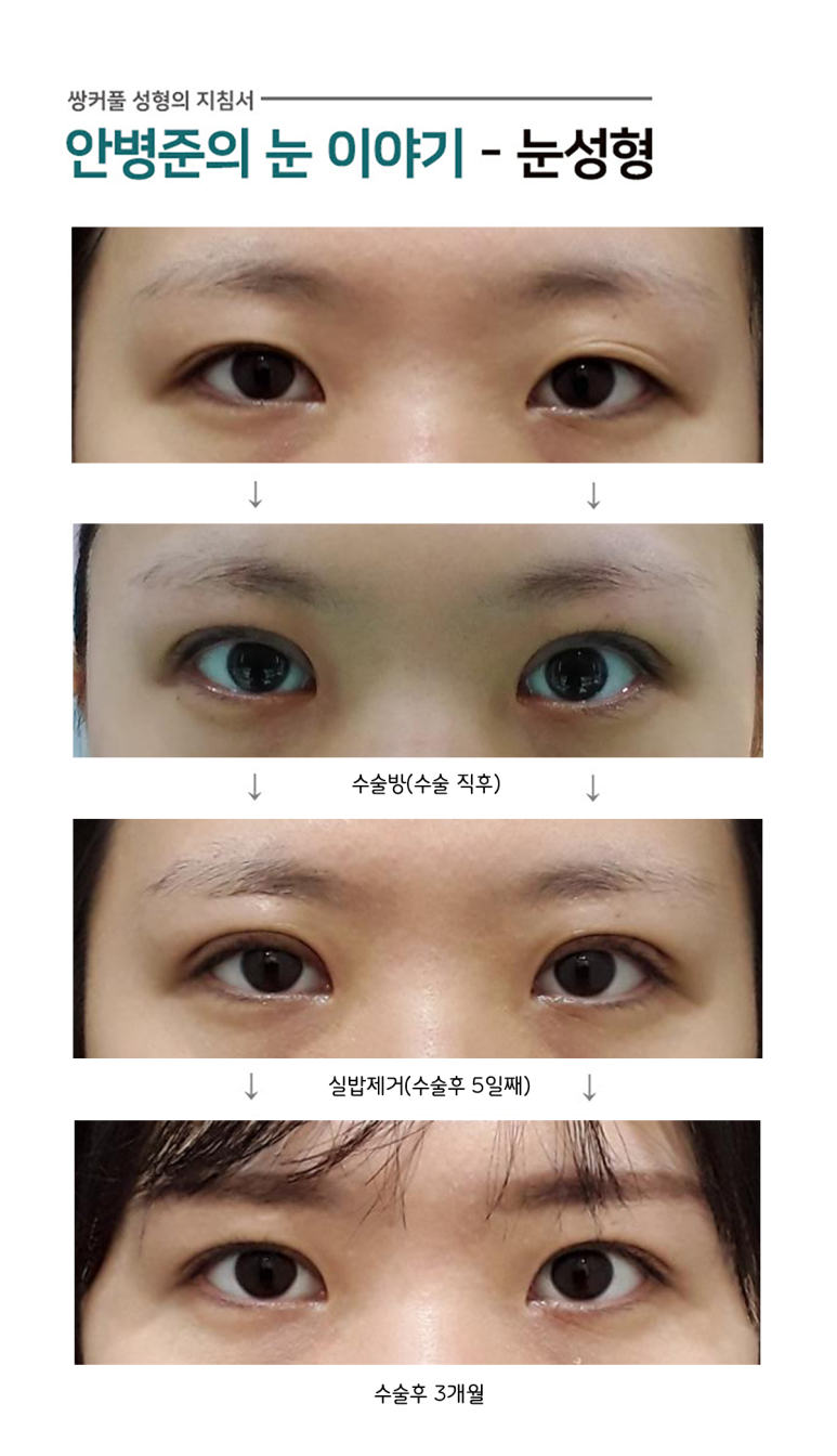 매몰법,절개법,재수술,안검하수 관련 이미지 1