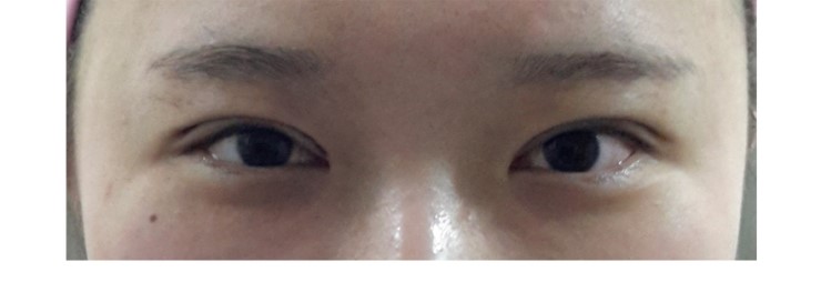 쌍꺼풀과 안검하수3개월후 관련 이미지 2