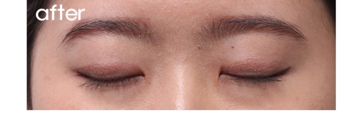 매몰법보다 절제술.(절개법,피부절제) 관련 이미지 2