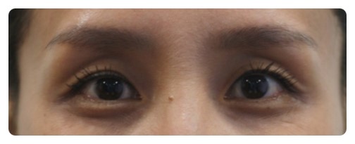 눈성형+눈지방이식 시크릿성형외과_안병준 관련 이미지 2