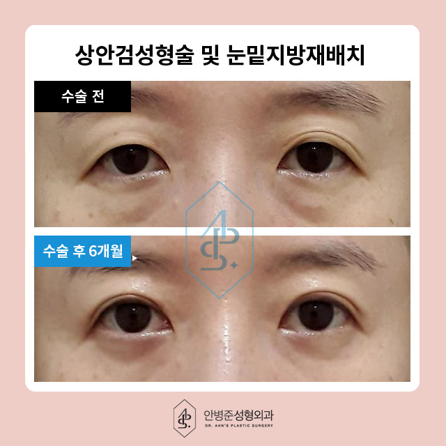 [이벤트] 상안검,하안검,눈썹거상 눈밑 지방재배치 관련 이미지 4