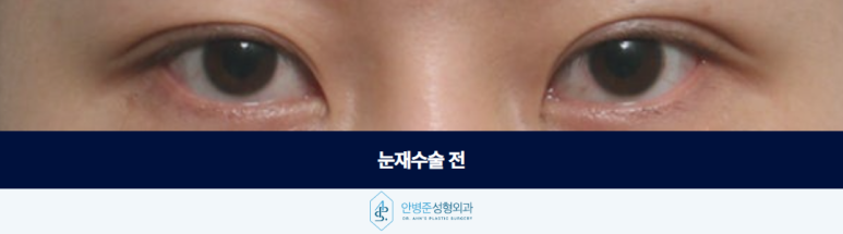 눈재수술 이전 수술의 흔적을 자연스럽게 디자인하는 과정 관련 이미지 2