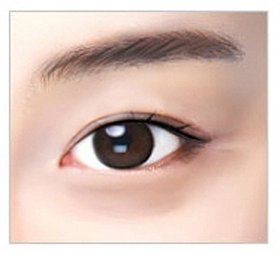안병준의 쌍꺼풀 지침서 10 _ 쌍꺼풀 라인의 유형(인라인과 아웃라인) 관련 이미지 1