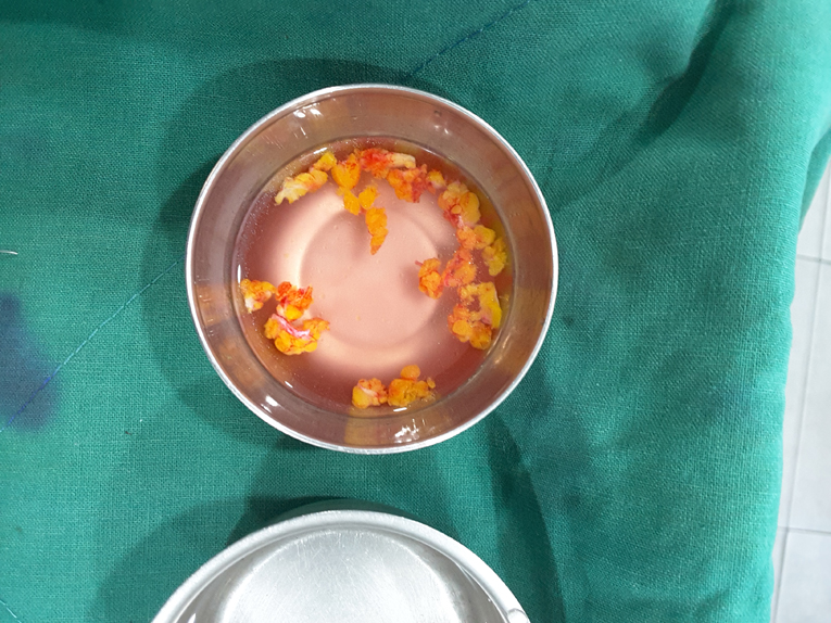 효과 좋은 지방이식 방법 관련 이미지 5