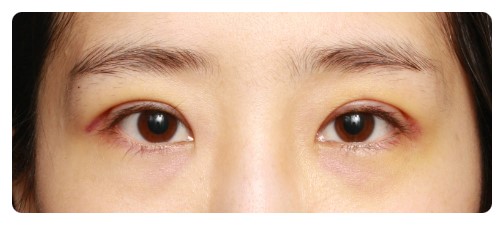 눈성형 4개월후 경과사진 관련 이미지 2