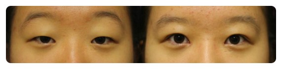 -가짜 안검하수와 진짜 안검하수-        [안병준의 눈이야기] 관련 이미지 4