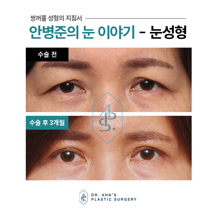 [눈썹밑상안검] 졸려보이는 눈매 및 처진 눈꺼풀 개선 관련 이미지 3