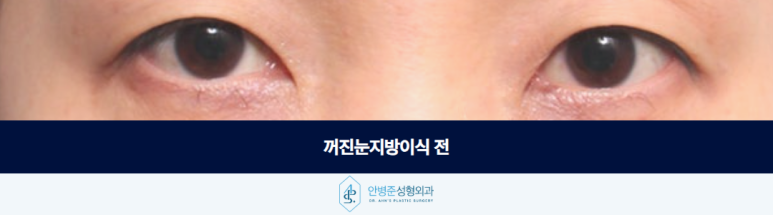 꺼진눈지방이식 눈 위가 꺼져 보인다면 구조부터 살펴야 합니다 관련 이미지 2