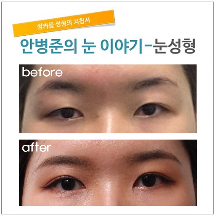 가성안검하수. 관련 이미지 1