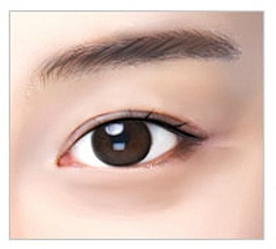 안병준의 쌍꺼풀 지침서 10 _ 쌍꺼풀 라인의 유형(인라인과 아웃라인) 관련 이미지 3