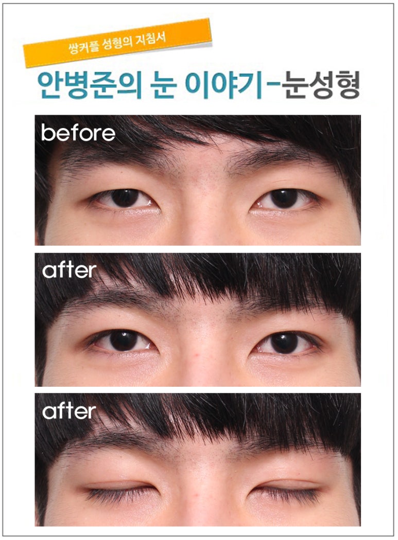 재수술이 늘어나는 남자 쌍꺼풀 관련 이미지 1