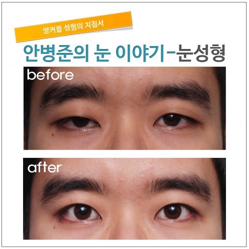 짝짝이눈과 안검하수 관련 이미지 1
