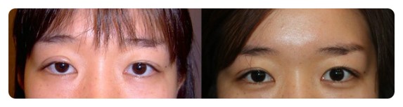 -쌍꺼풀 라인크기의 중요성-                [안병준의 눈이야기] 관련 이미지 1