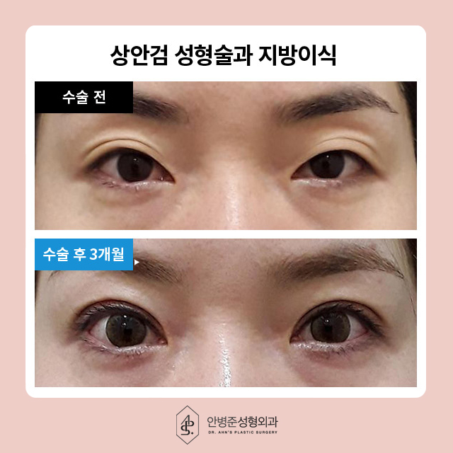 [이벤트] 상안검,하안검,눈썹거상 눈밑 지방재배치 관련 이미지 2
