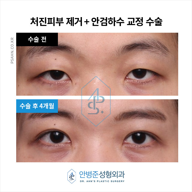 삼백안 교정 수술로 자연스럽고 편안한 눈매 완성~! 관련 이미지 1