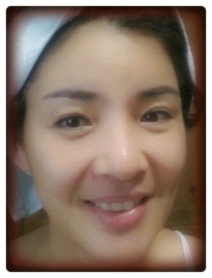 *상안검성형술*                      [안병준의 눈이야기] 관련 이미지 2