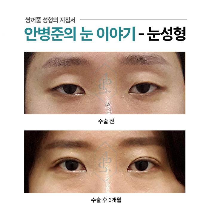 안면 비대칭에 의한 짝눈 쌍꺼풀 - 자연스러운 교정 관련 이미지 1